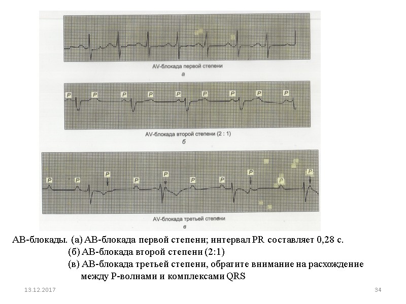 13.12.2017 34 AВ-блокады. (а) AВ-блокада первой степени; интервал PR составляет 0,28 с.  